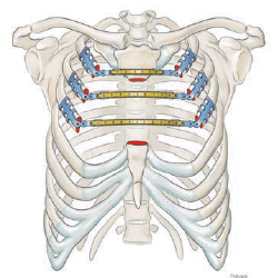 Parasternal reconstruction